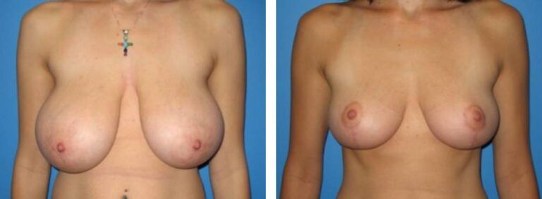 Breast Reduction case 2_1