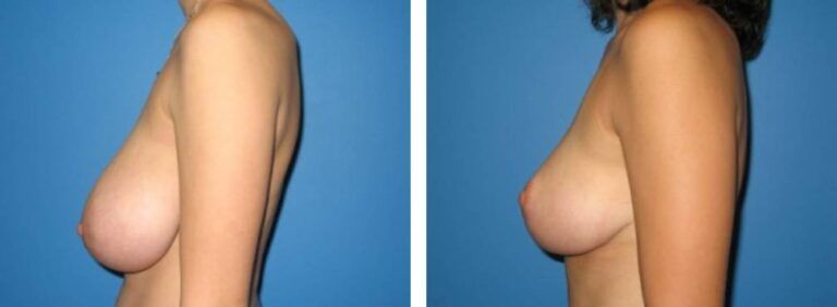 Breast Reduction case 2_2