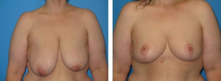 Breast Reduction case 30_1
