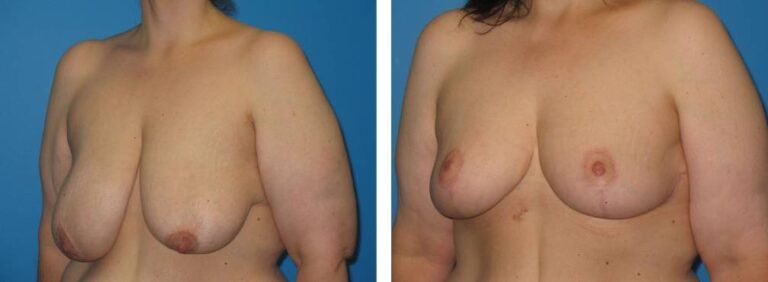 Breast Reduction case 30_2