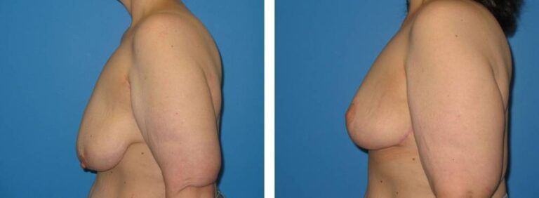 Breast Reduction case 30_3