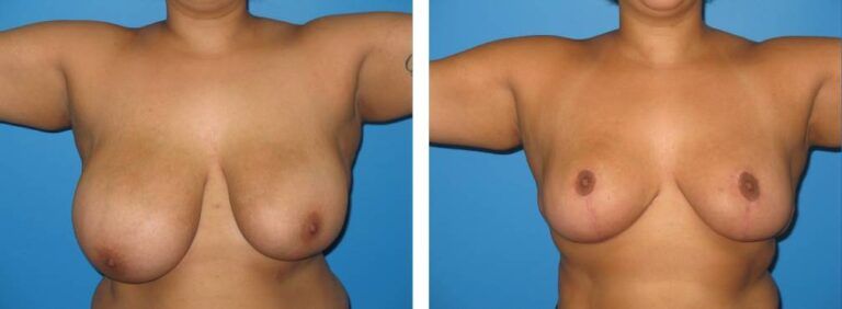 Breast Reduction case 31_1