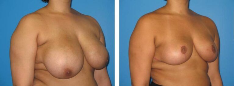 Breast Reduction case 31_2