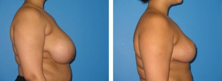 Breast Reduction case 31_3