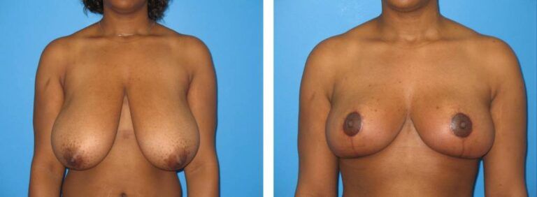 Breast Reduction case 32_1