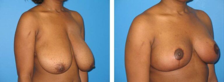 Breast Reduction case 32_2