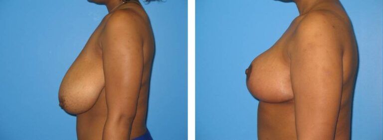 Breast Reduction case 32_3