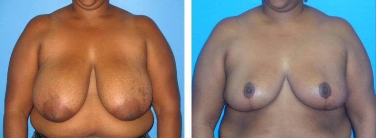Breast Reduction case 33