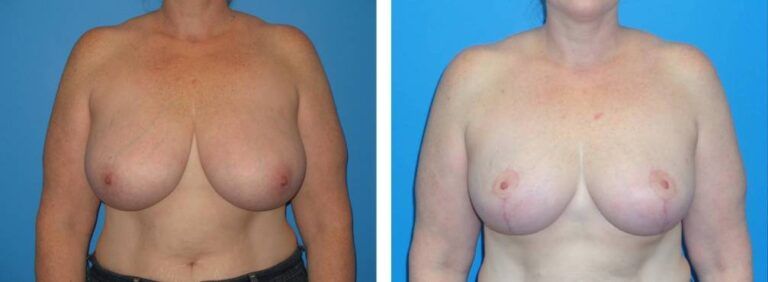 Breast Reduction case 34
