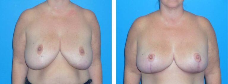 Breast Reduction case 37
