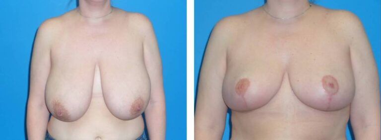 Breast Reduction case 38_1
