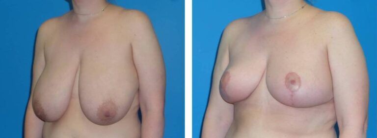 Breast Reduction case 38_2