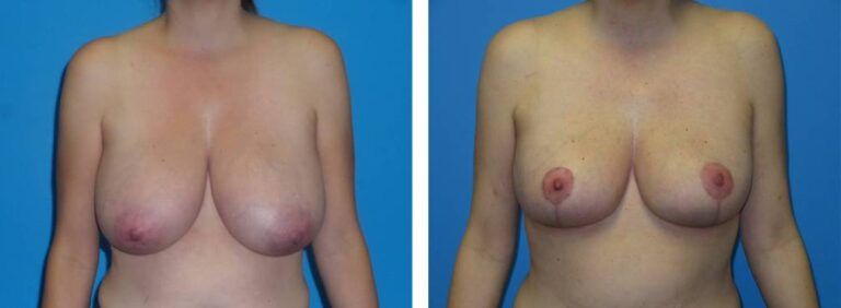 Breast Reduction case 39_1