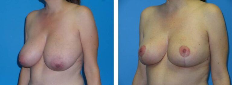 Breast Reduction case 39_2