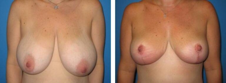 Breast Reduction case 3_1