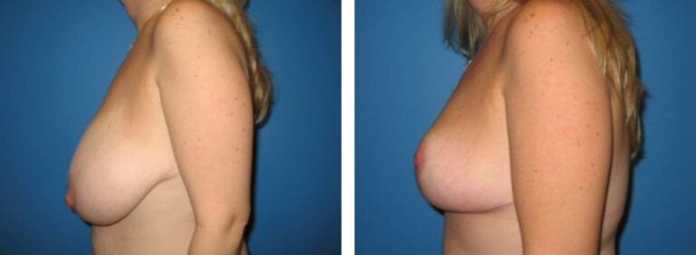 Breast Reduction case 3_2
