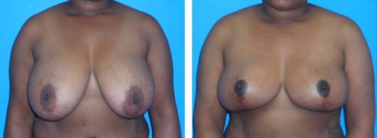Breast Reduction case 40_1