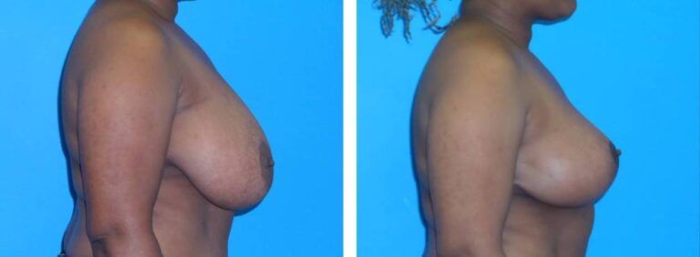 Breast Reduction case 40_2