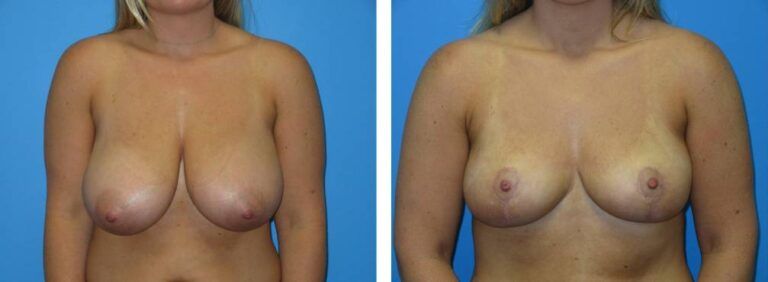 Breast Reduction case 42_1