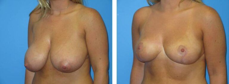 Breast Reduction case 42_2