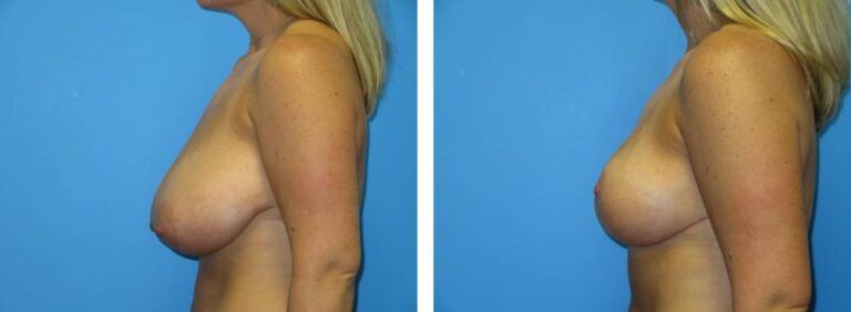 Breast Reduction case 42_3