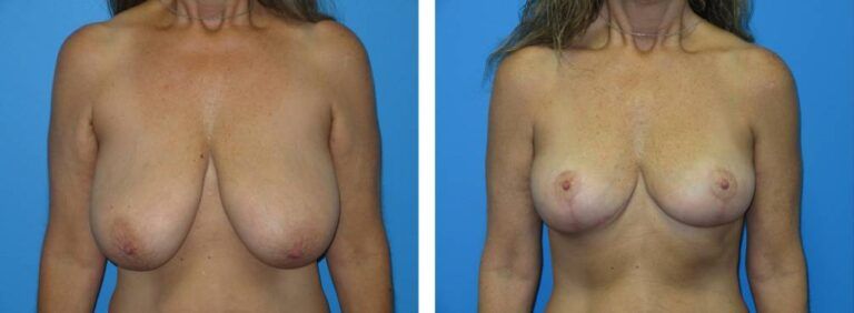Breast Reduction case 43_1