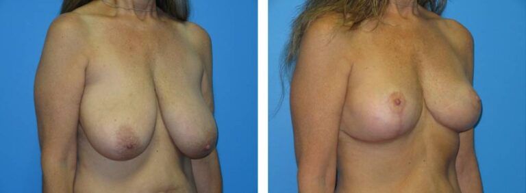 Breast Reduction case 43_2