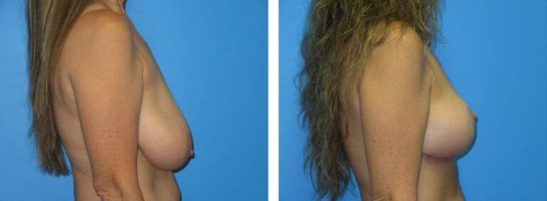 Breast Reduction case 43_3