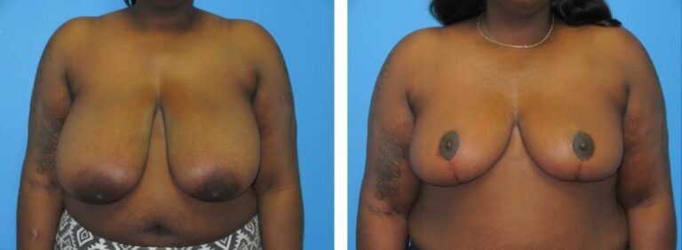 Breast Reduction case 44_1