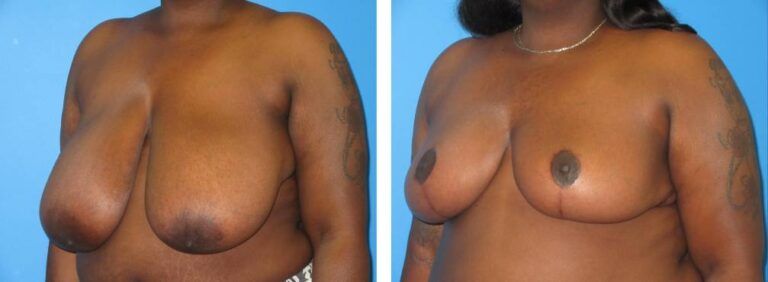 Breast Reduction case 44_2