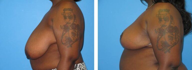 Breast Reduction case 44_3