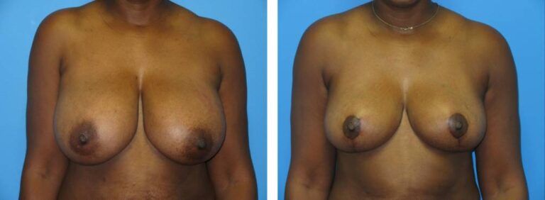 Breast Reduction case 45_1