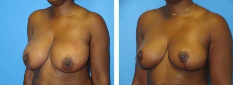 Breast Reduction case 45_2