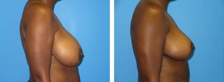 Breast Reduction case 45_3