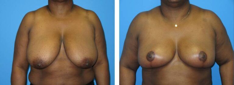 Breast Reduction case 46_1