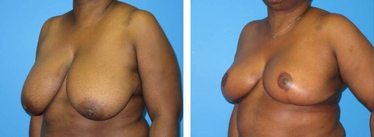 Breast Reduction case 46_2