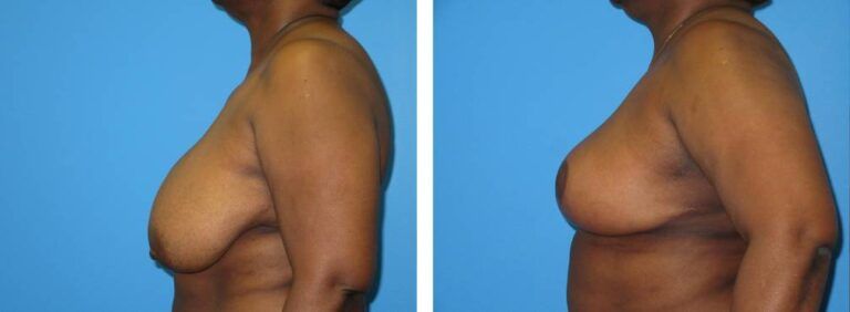 Breast Reduction case 46_3