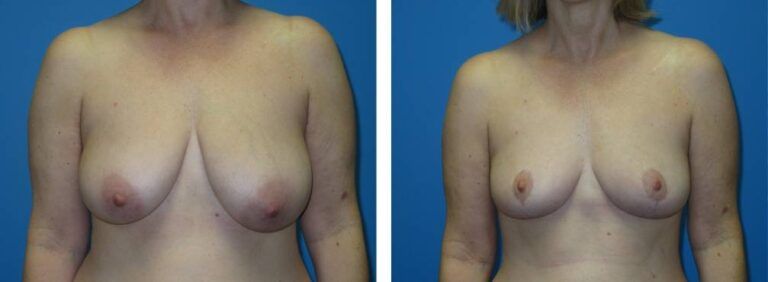 Breast Reduction case 47_1