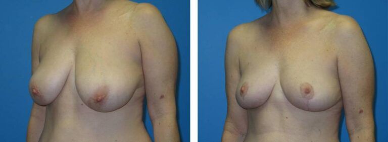Breast Reduction case 47_2