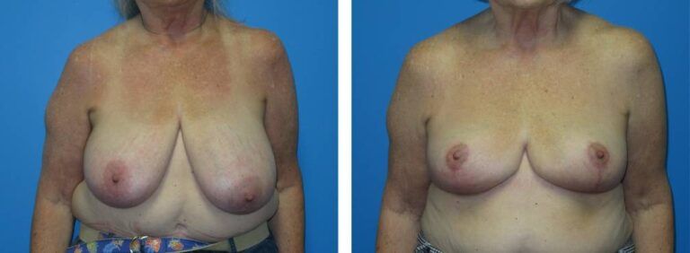 Breast Reduction case 48_1