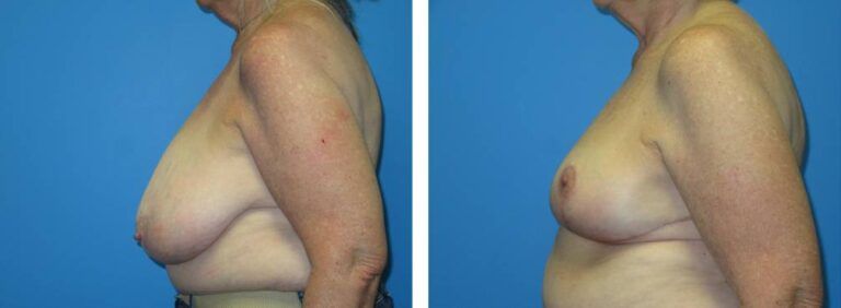 Breast Reduction case 48_2