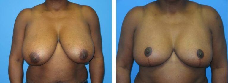 Breast Reduction case 49_1