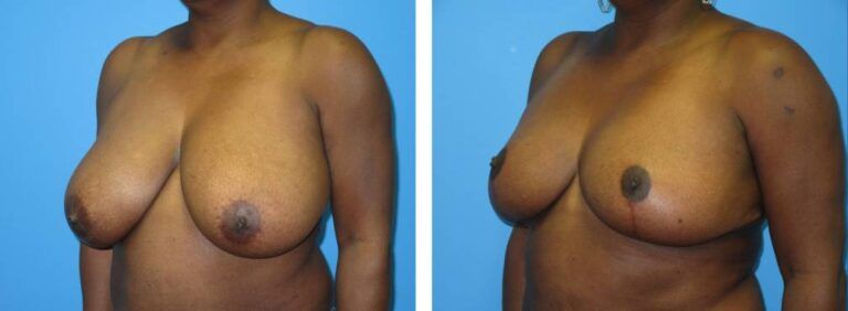 Breast Reduction case 49_2