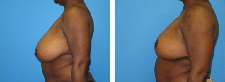 Breast Reduction case 49_3