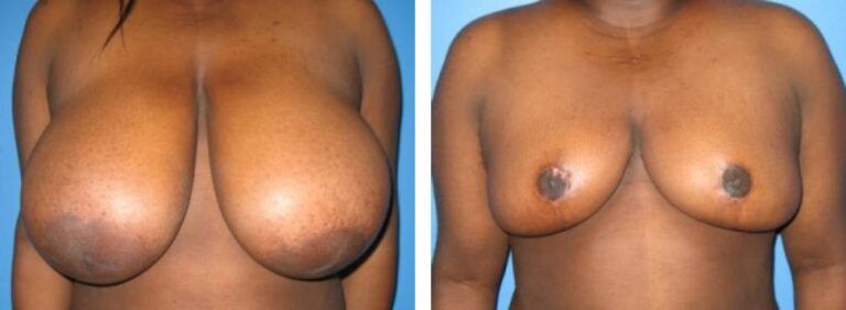 Breast Reduction case 4_1