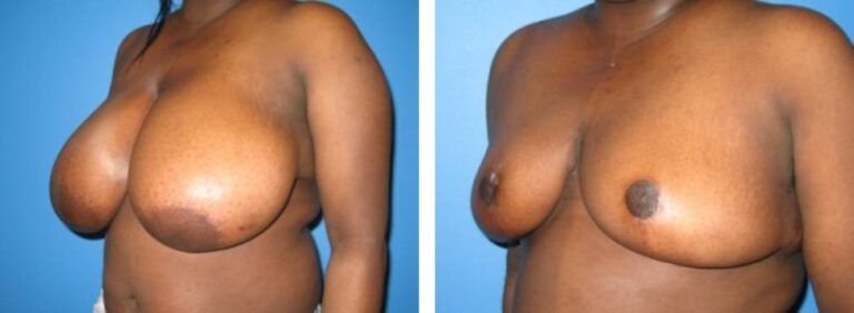 Breast Reduction case 4_2