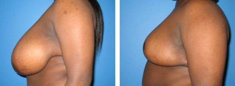 Breast Reduction case 4_3