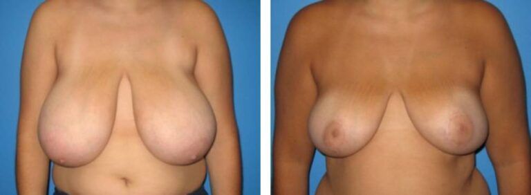Breast Reduction case 5_1