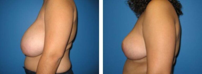Breast Reduction case 5_2