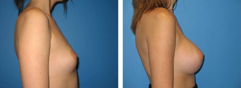 Breast augmentation case 1